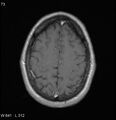 Neurosarcoidosis (Radiopaedia 10930-17204 Axial T1 C+ 16).jpg