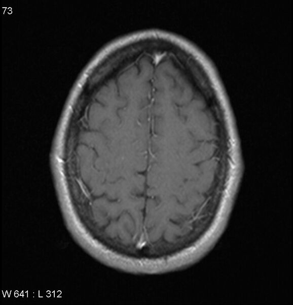 File:Neurosarcoidosis (Radiopaedia 10930-17204 Axial T1 C+ 16).jpg