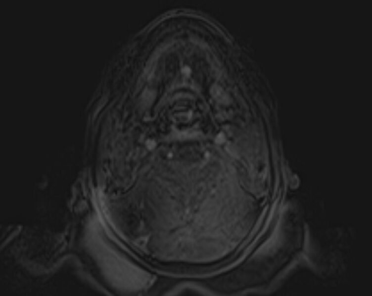 File:Non-Hodgkin lymphoma - parotid gland (Radiopaedia 71531-81890 E 25).jpg