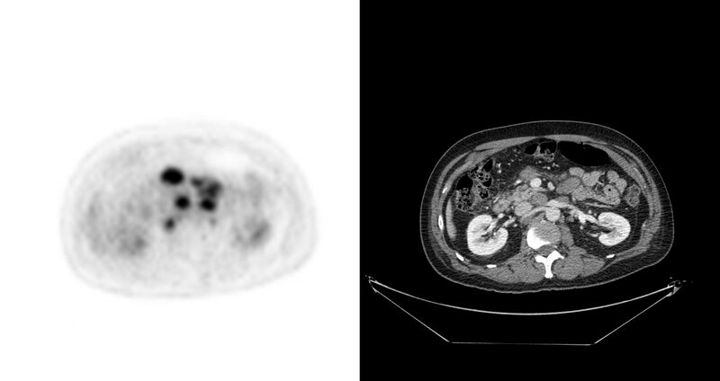 File:Non-Hodgkin lymphoma involving seminal vesicles with development of interstitial pneumonitis during Rituximab therapy (Radiopaedia 32703-33675 axial PET CT 30).jpg