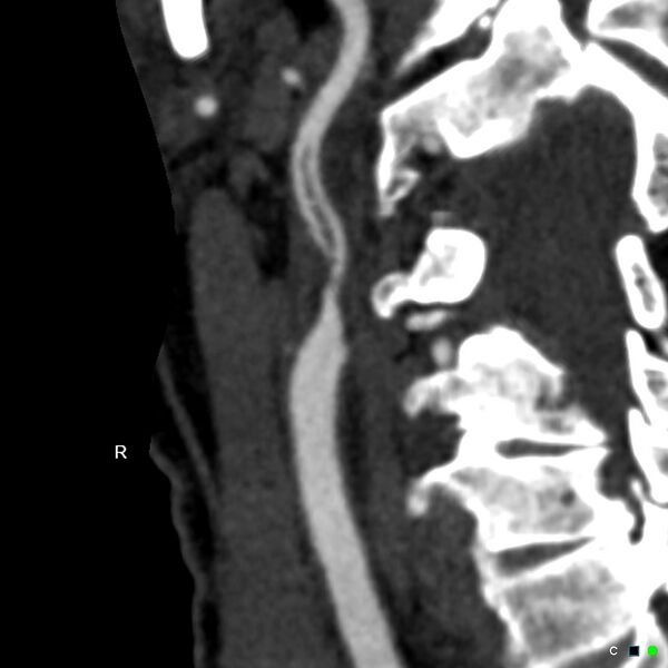 File:Non-occlusive intraluminal internal carotid artery thrombus (Radiopaedia 37751-39658 A 68).jpg