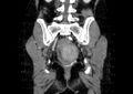 Non-puerperal uterine inversion (Radiopaedia 78343-91094 B 46).jpg
