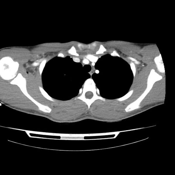 File:Normal dual-phase trauma CT chest,abdomen and pelvis (Radiopaedia 48092-52899 A 11).jpg