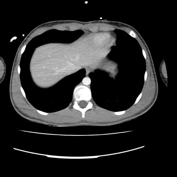 File:Normal dual-phase trauma CT chest,abdomen and pelvis (Radiopaedia 48092-52899 A 45).jpg