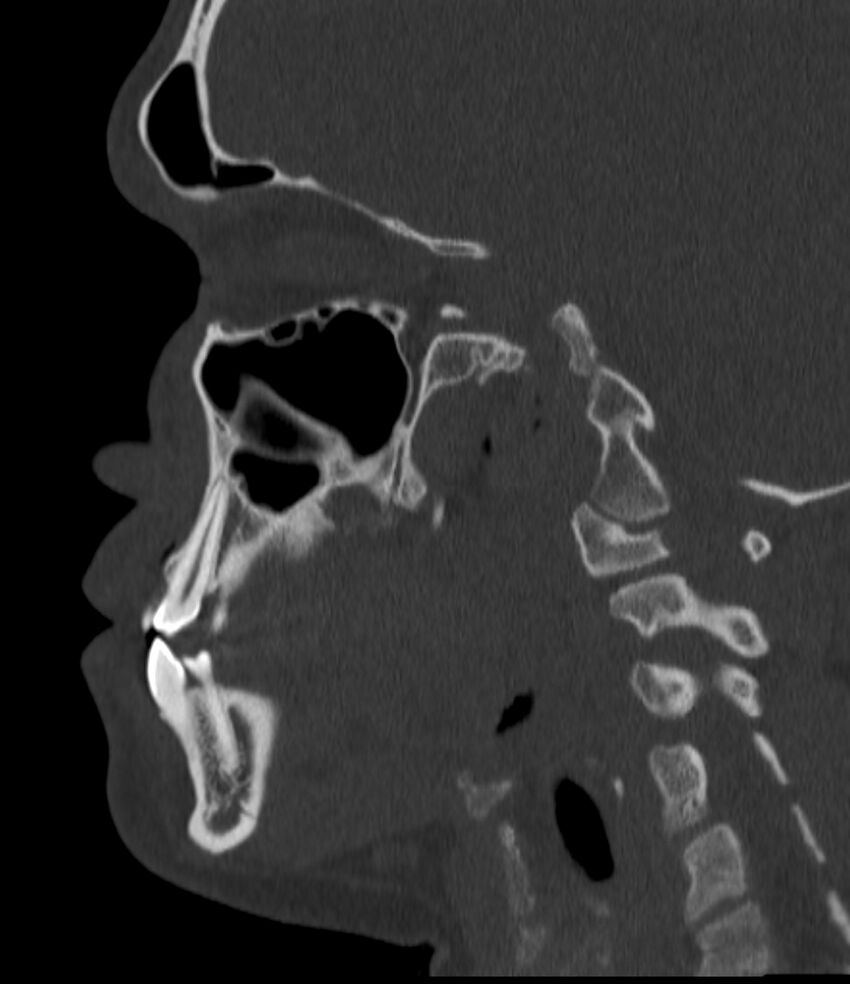 Normal facial bone CT (Radiopaedia 88742-105476 Sagittal bone window 102).jpg