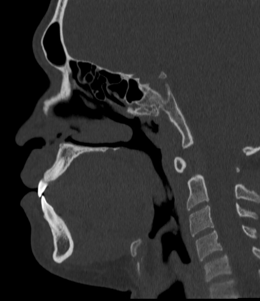 Normal facial bone CT (Radiopaedia 88742-105476 Sagittal bone window 94).jpg