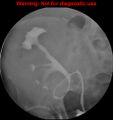 Normal retrograde pyelography of a native and transplant kidney (Radiopaedia 40480-43054 Transplant kidney 17).jpg
