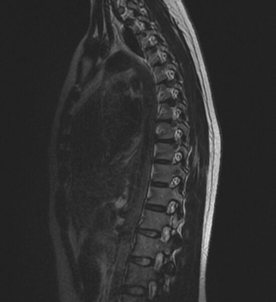 File:Normal thoracic spine MRI (Radiopaedia 41033-43781 Sagittal T2 10).jpg