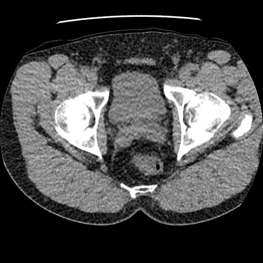 Obstructing ureteric calculus and ureteric anatomy (Radiopaedia 62730-71042 Axial non-contrast 162).jpg