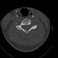 Occipital condyle fracture (Radiopaedia 31755-32691 Axial bone window 41).jpg