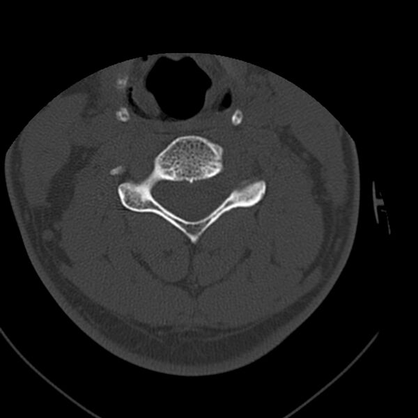 File:Occipital condyle fracture (Radiopaedia 31755-32691 Axial bone window 41).jpg