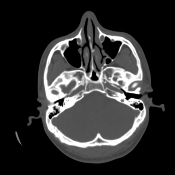 File:Occipital spur - asymptomatic (Radiopaedia 87753-104201 Axial bone window 31).jpg