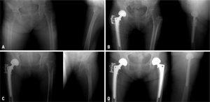 a) Initial radiographs of intertrochanteric fracture b) postoperative - bipolar hemiarthroplasty c) subsequent fracture in left femur neck d) radiograph after a bipolar hemiarthroplasty, the individual began medication for osteoporosis