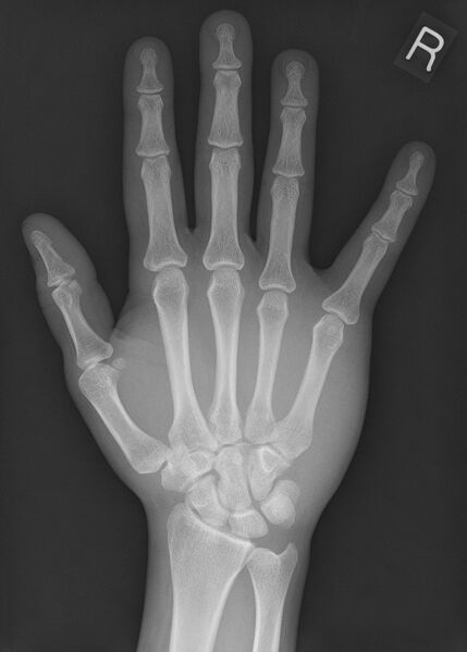 File:5th metacarpal fracture (Radiopaedia 47003).jpg