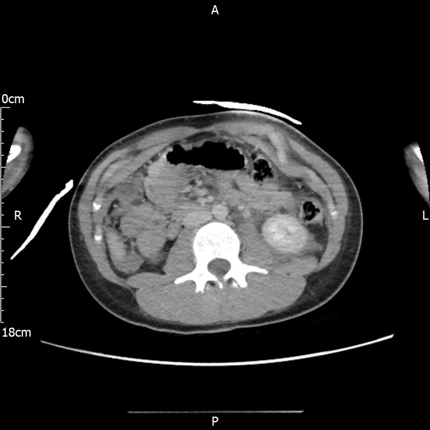 AAST grade IV kidney injury with CEUS follow-up (Radiopaedia 72353-82877 Axial C+ portal venous phase 33).jpg