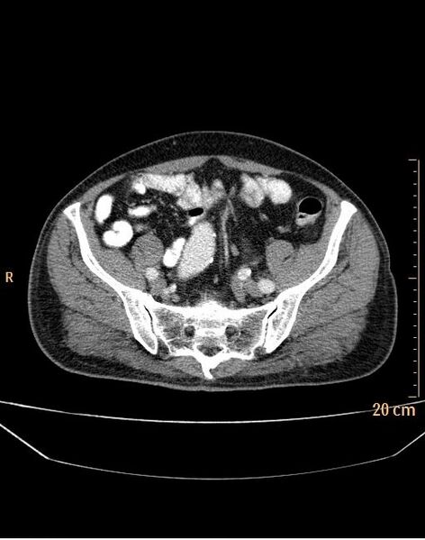 File:Abdominal aortic aneurysm (Radiopaedia 25985-26121 Axial C+ arterial phase 34).jpg