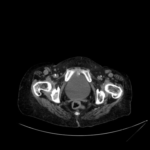File:Abdominal aortic aneurysm - impending rupture (Radiopaedia 19233-19246 Axial non-contrast 124).jpg
