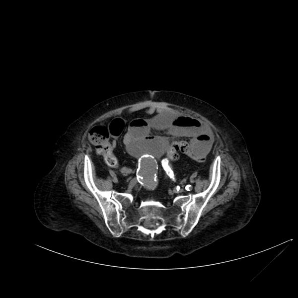 File:Abdominal aortic aneurysm - impending rupture (Radiopaedia 19233-19246 Axial non-contrast 95).jpg