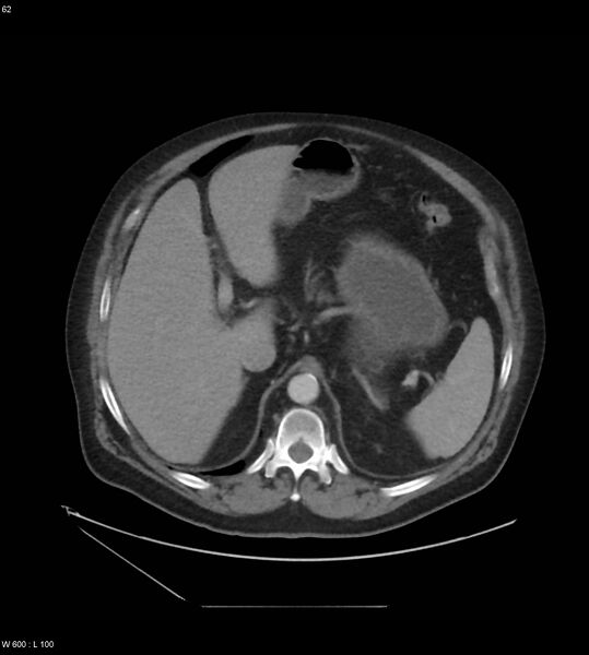 File:Abdominal aortic aneurysm with intramural hematoma then rupture (Radiopaedia 50278-55631 Axial C+ arterial phase 53).jpg