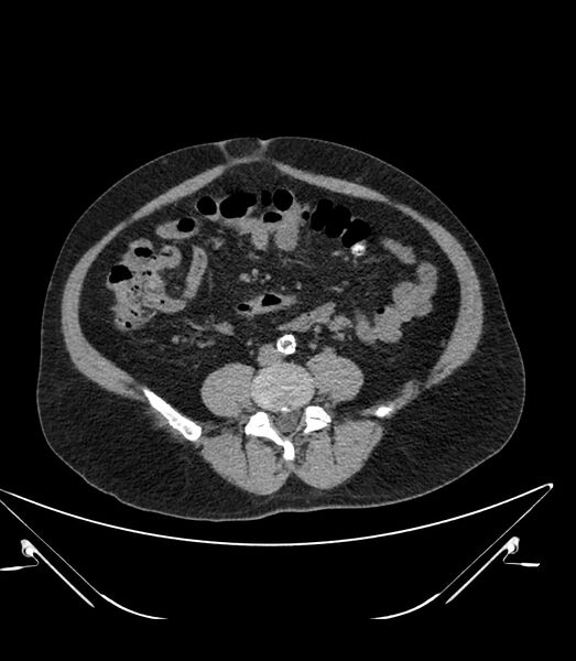 File:Abdominal aortic aneurysm with thrombus fissuration (Radiopaedia 46218-50618 Axial non-contrast 34).jpg