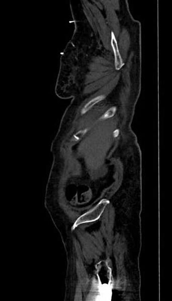 File:Abdominal aortic aneurysm with thrombus fissuration (Radiopaedia 73192-83919 Sagittal C+ arterial phase 133).jpg