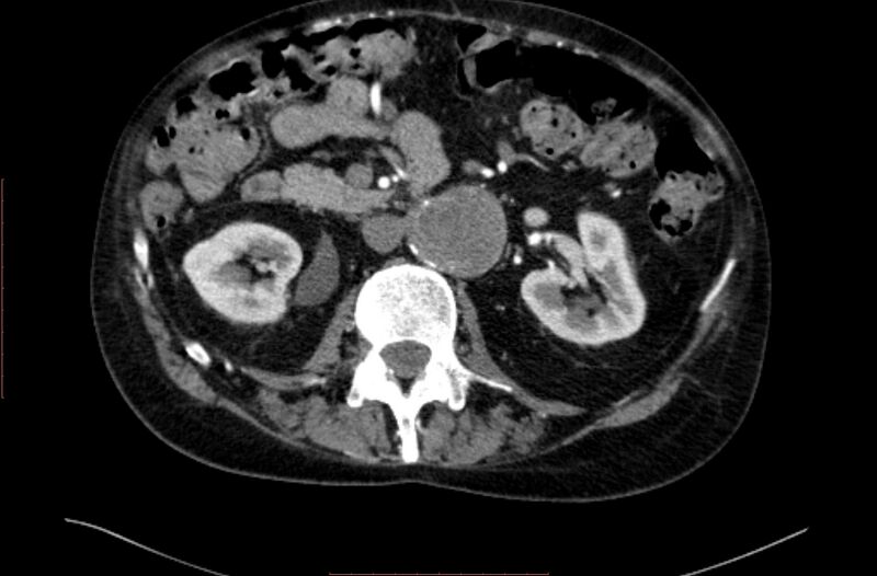 File:Abdominal aortic interposition tube graft and aneurysm thrombosis (Radiopaedia 71438-81857 Axial C+ arterial phase 61).jpg