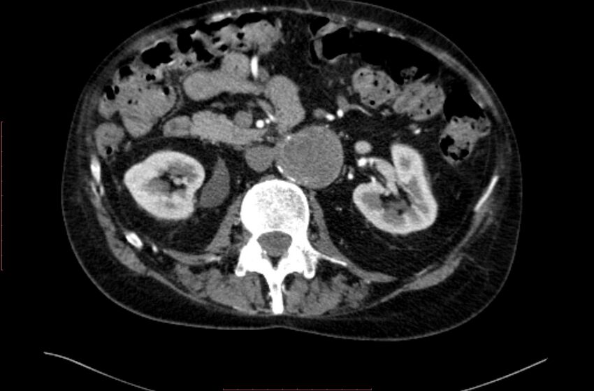 Abdominal aortic interposition tube graft and aneurysm thrombosis (Radiopaedia 71438-81857 Axial C+ arterial phase 61).jpg