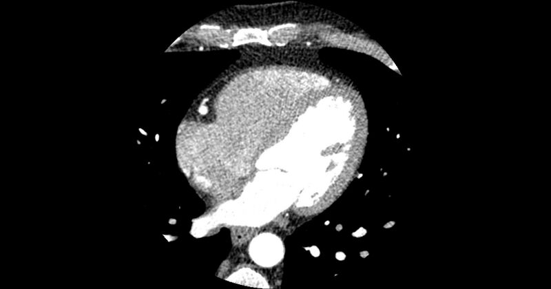 File:Aberrant left main coronary artery (ALMCA) arising from the right sinus with interarterial course (Radiopaedia 63251-71814 Axial C+ arterial phase 113).JPG