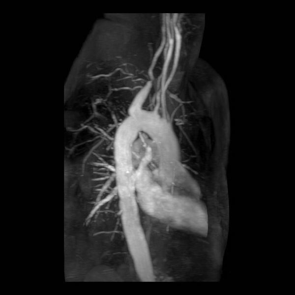 File:Aberrant right subclavian artery with background Takayasu arteritis (Radiopaedia 21423-21363 MRA 11).jpg