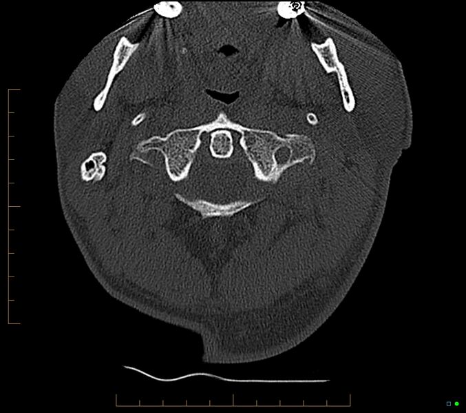 File:Accessory articulation of cervical transverse processes (Radiopaedia 82715-96933 Axial non-contrast 18).jpg