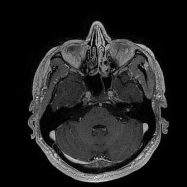 File:Acoustic schwannoma - intracanalicular (Radiopaedia 37247-39024 Axial T1 C+ 70).jpg