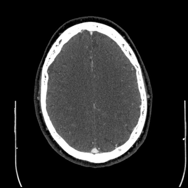File:Acute A3 occlusion with ACA ischemic penumbra (CT perfusion) (Radiopaedia 72036-82527 Axial C+ arterial phase thins 14).jpg