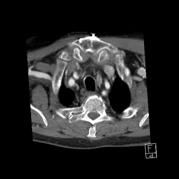 File:Acute ICA ischemic penumbra due to high-grade CCA stenosis (CT perfusion) (Radiopaedia 72038-82530 Axial C+ arterial phase 71).jpg