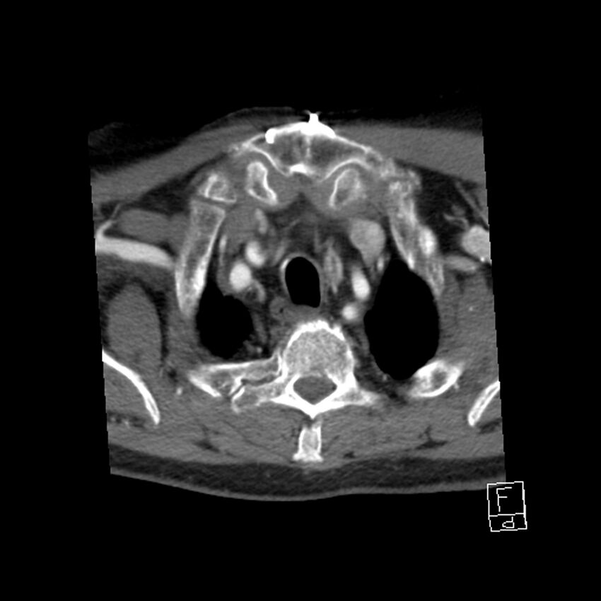 Acute ICA ischemic penumbra due to high-grade CCA stenosis (CT perfusion) (Radiopaedia 72038-82530 Axial C+ arterial phase 71).jpg
