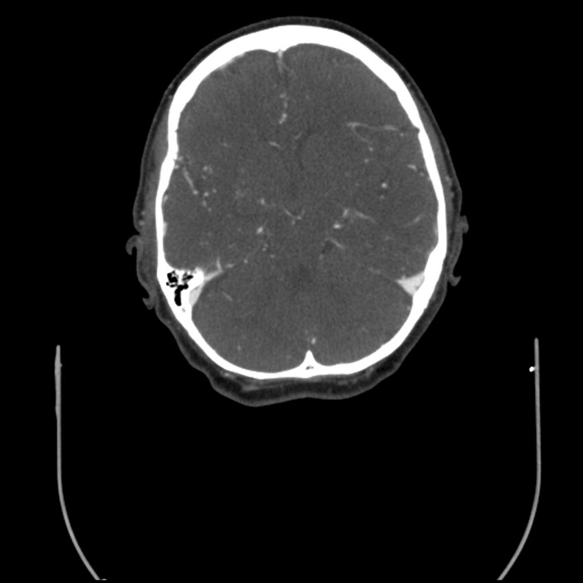 Acute M1 occlusion with ischemic penumbra (CT perfusion) (Radiopaedia 71897-82344 Axial C+ arterial phase thins 78).jpg