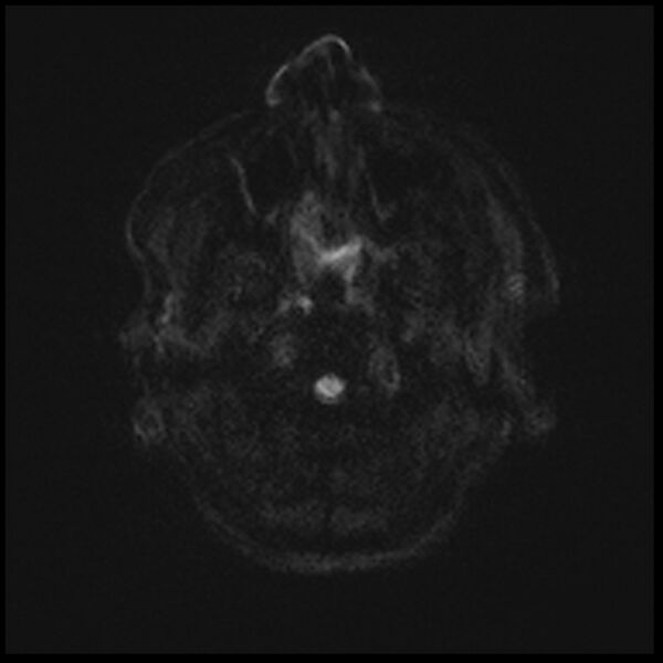 File:Acute P1 occlusion with PCA ischemia penumbra (CT perfusion) (Radiopaedia 72084-82590 Axial DWI 1).jpg