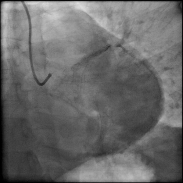 File:Acute anteroseptal myocardial infarction (Radiopaedia 68409-77946 LAO caudal (spider view) LAD and CX 73).jpg