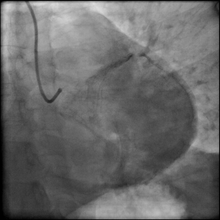 Acute anteroseptal myocardial infarction (Radiopaedia 68409-77946 LAO caudal (spider view) LAD and CX 73).jpg