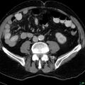 Acute appendicitis arising from a malrotated cecum (Radiopaedia 19970-19997 Axial C+ portal venous phase 22).jpg