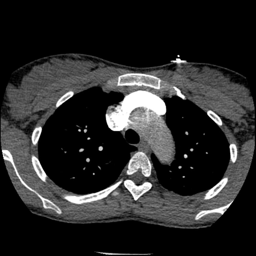 Acute chest syndrome - sickle cell disease (Radiopaedia 42375-45499 Axial C+ CTPA 51).jpg
