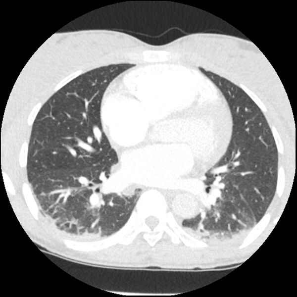 File:Acute chest syndrome - sickle cell disease (Radiopaedia 42375-45499 Axial lung window 108).jpg