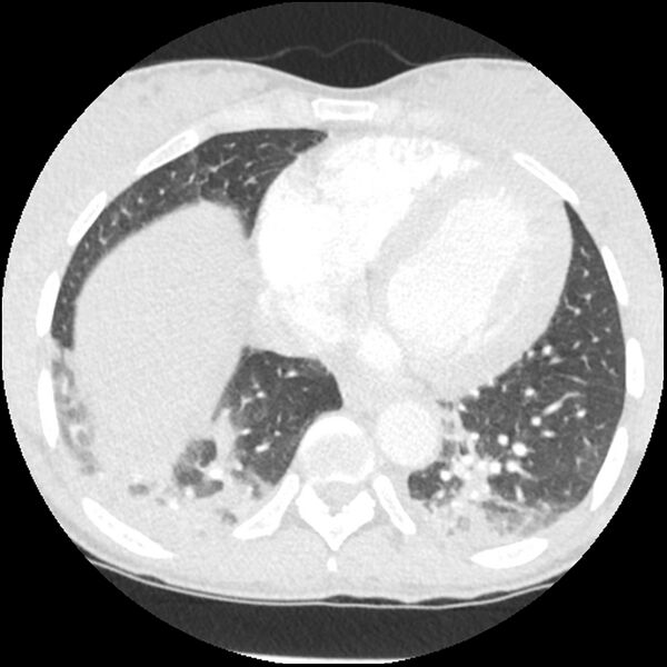 File:Acute chest syndrome - sickle cell disease (Radiopaedia 42375-45499 Axial lung window 140).jpg