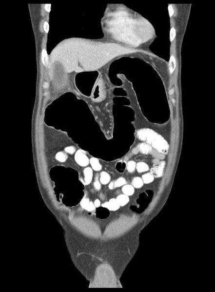 File:Acute cholecystitis (Radiopaedia 29814-30327 Coronal C+ portal venous phase 14).jpg