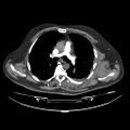 Acute heart failure (CT) (Radiopaedia 79835-93075 Axial C+ arterial phase 5).jpg