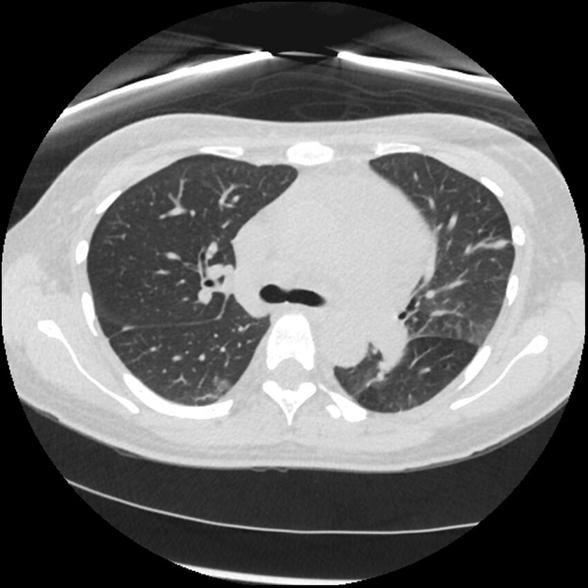 Acute lupus nephritis (Radiopaedia 45832-50107 Axial lung window 34).jpg