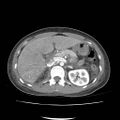 Acute myocarditis (Radiopaedia 55988-62613 Axial C+ portal venous phase 25).jpg
