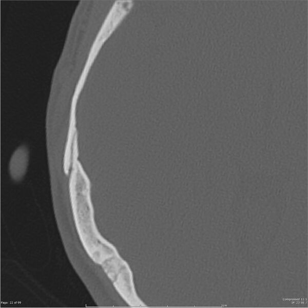 File:Acute otomastoiditis (Radiopaedia 28276-28512 Axial PTB bone window reformat 2).jpg
