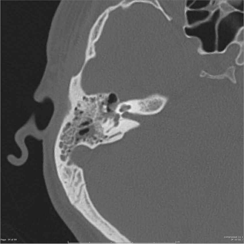 Acute otomastoiditis (Radiopaedia 28276-28512 Axial PTB bone window reformat 34).jpg