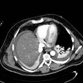 Acute pancreatic necrosis (Radiopaedia 13560-13486 Axial C+ portal venous phase 16).jpg