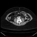 Acute pancreatitis - Balthazar C (Radiopaedia 26569-26714 Axial C+ portal venous phase 60).jpg